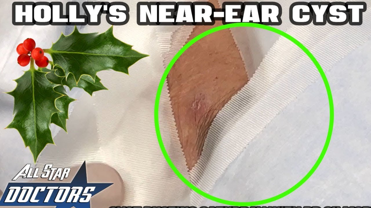 Holly's Near-Ear Cyst Removal, Pimple Popping & Dermatology
