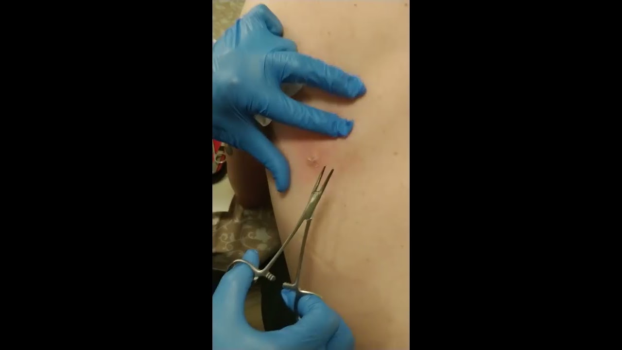 Home cyst removal (mute sound to avoid gagging)