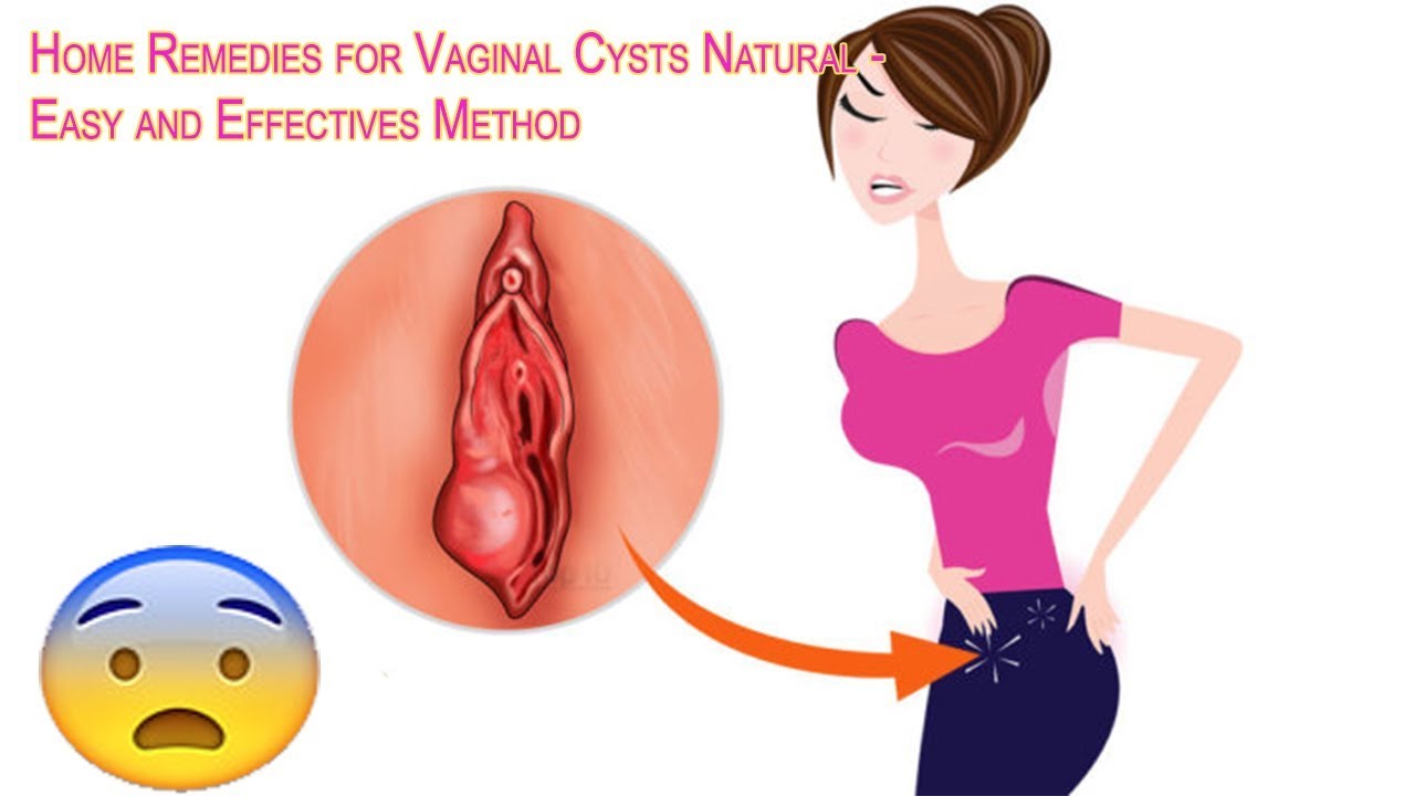Home Remedies for V Cysts Natural – Easy and Effectives Method