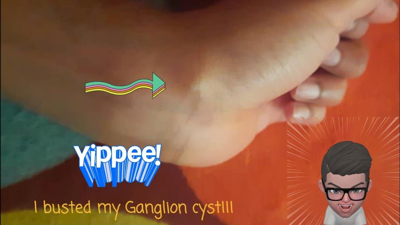 Home remedy for a Ganglion cyst in wrist (carpal area)| Popping a Ganglion cyst  | DIY