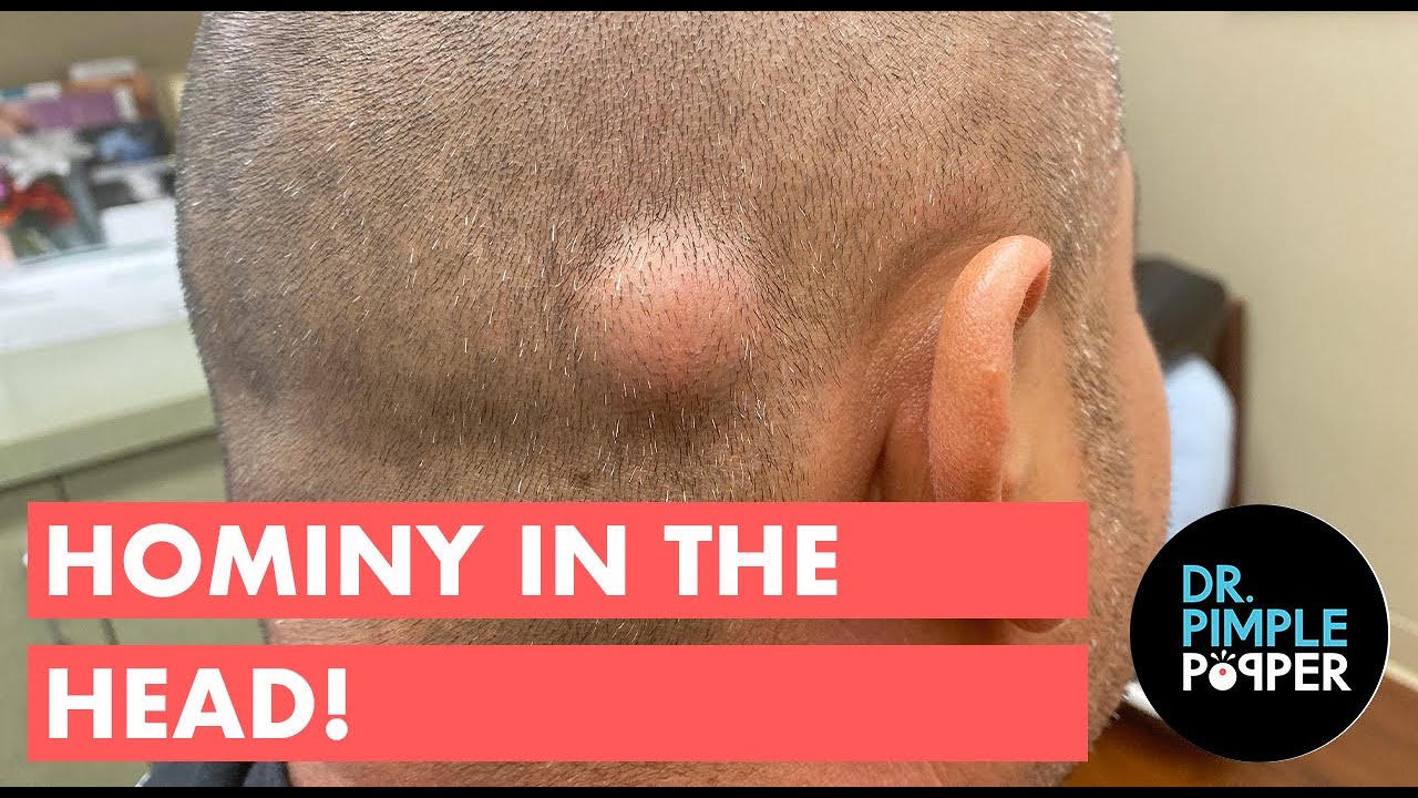 Hominy in the Head! A Pasole Pilar Cyst!