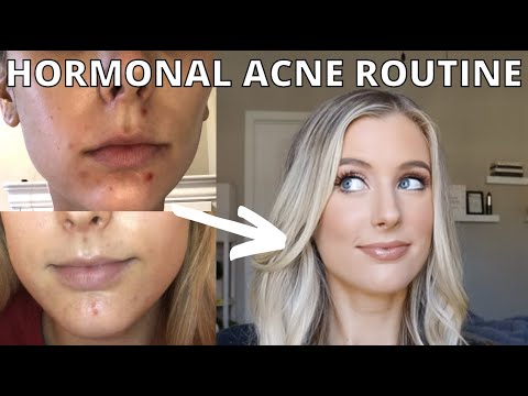 Hormonal Acne Skin Care Routine | Hormonal Cystic Acne Skincare Update #hormonalacne