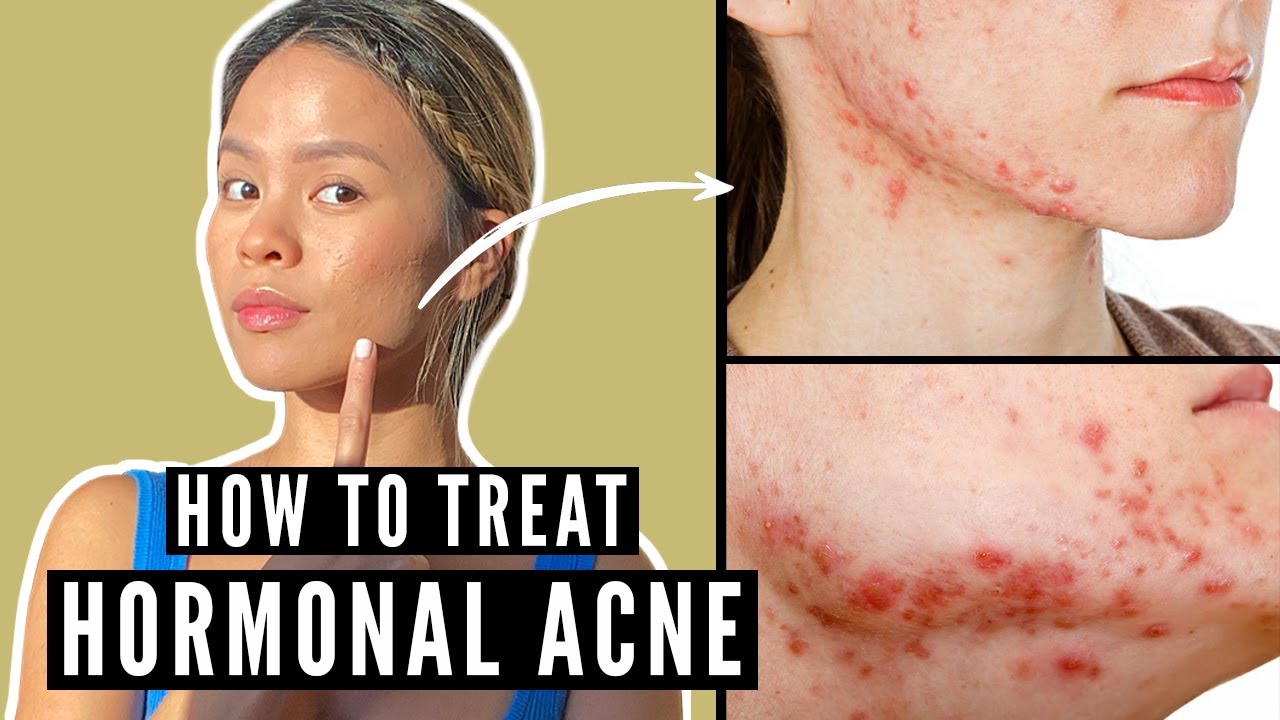 Hormonal Acne Treatment — Say Hello and Goodbye to Them!