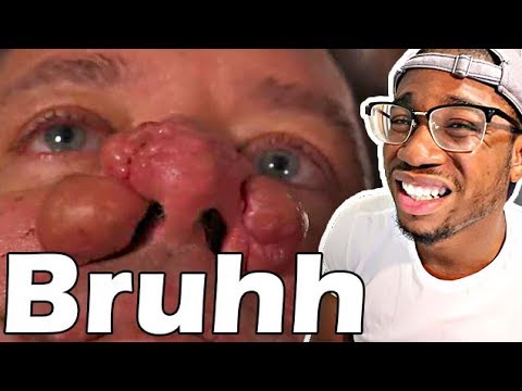 HORRIBLE AND NASTY PIMPLE POPPING COMPILATION!!!