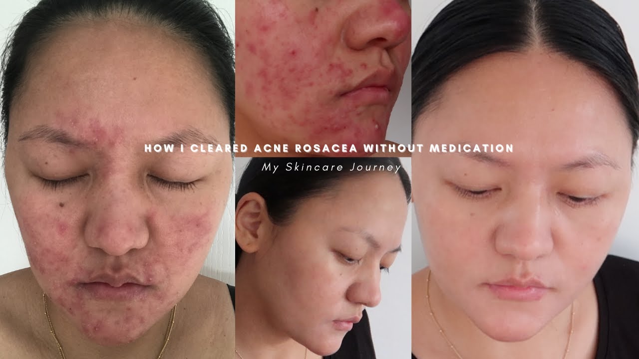 How I cleared acne rosacea without medication⎜Skincare journey & routine