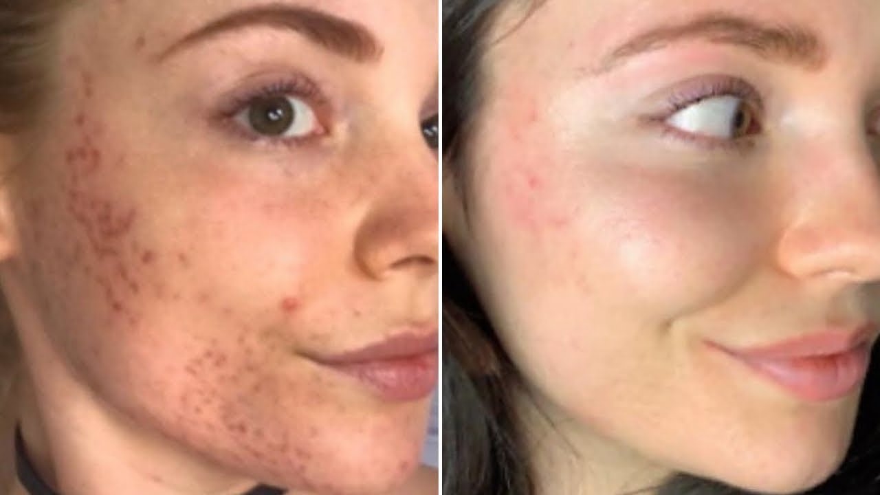 How I Cleared my Acne Scars at Home