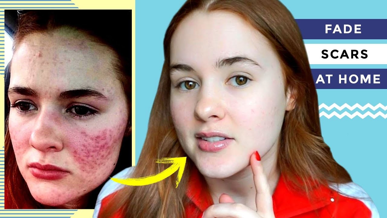 How I Cleared my Acne Scars At Home