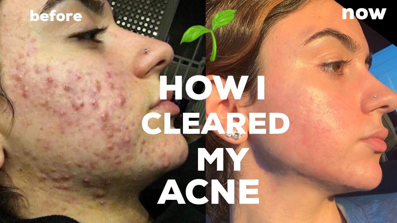 HOW I CLEARED MY CYSTIC ACNE *NATURALLY* + TIPS