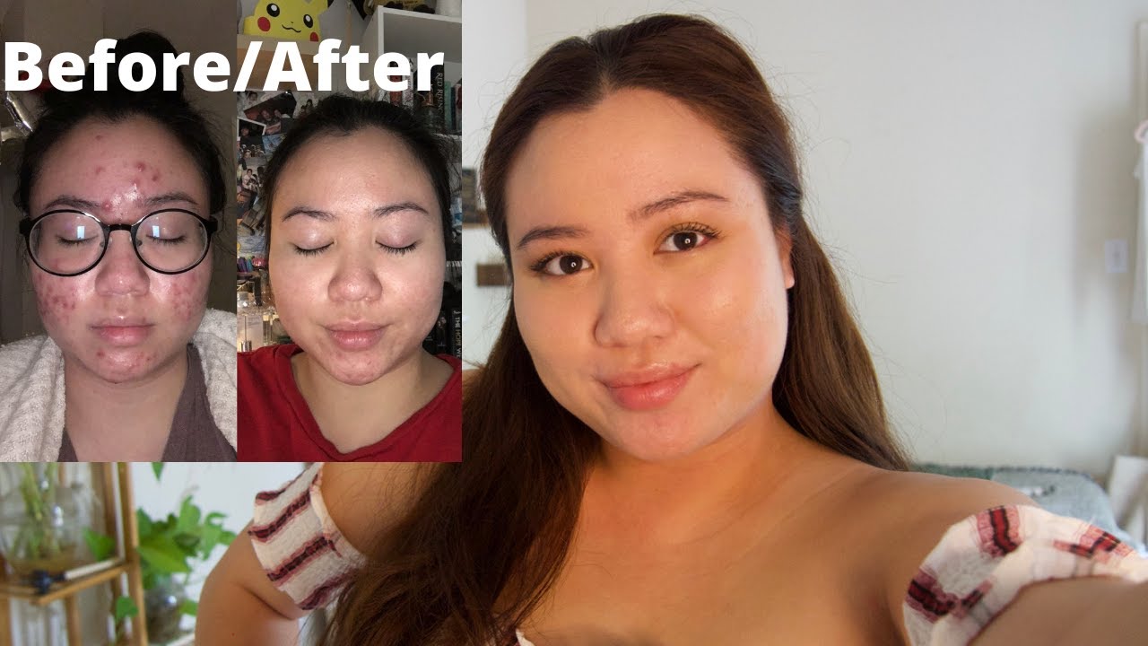 How I cleared my cystic acne- NO Accutane | Clear acne naturally + what caused my acne