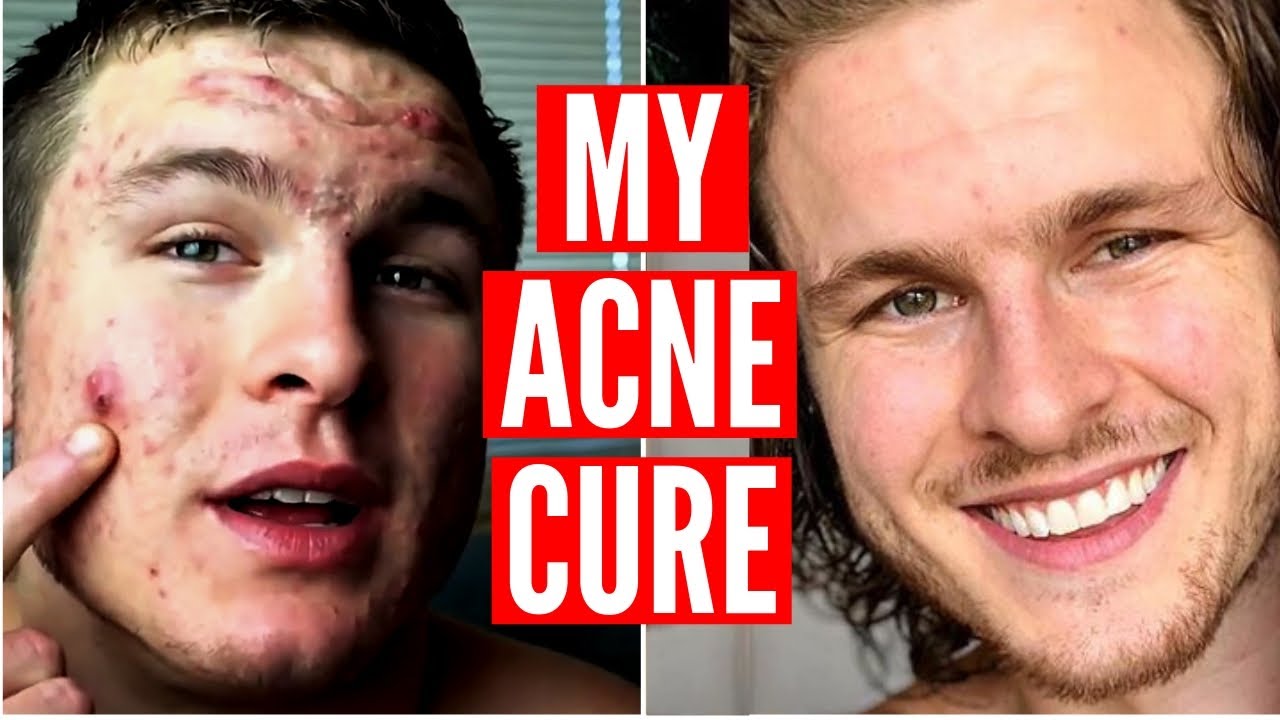 How I Cured My Acne At Home| ft. Brian Turner