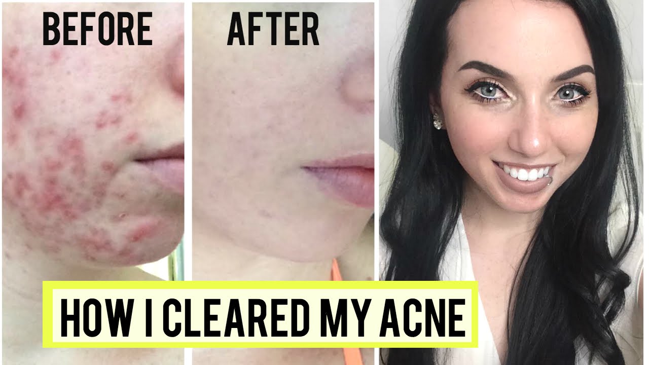 HOW I GOT RID OF CYSTIC ACNE! Skincare Favorites & Clear Skin Tips