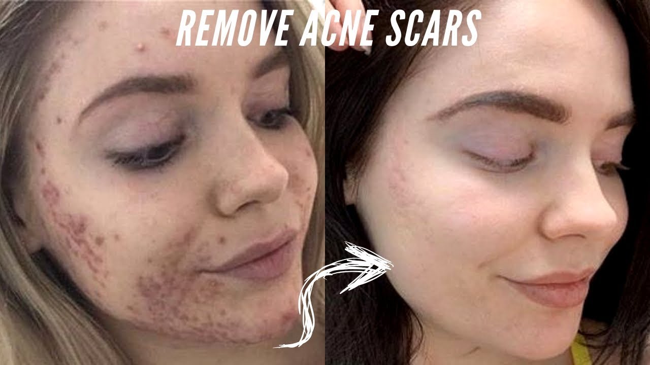 How I Got Rid of my Acne Scars by Microneedling