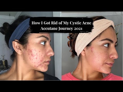 How I Got Rid of My Cystic Acne | Accutane Journey 2021 | Life After Accutane | VALERIE GONZALEZ