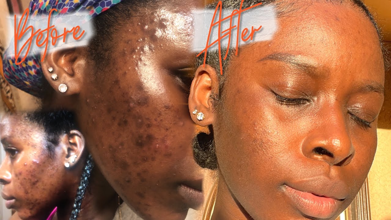 HOW I GOT RID OF MY HYPERPIGMENTATION & CYSTIC ACNE FAST AF + SKIN CARE JOURNEY *HIGHLY REQUESTED*
