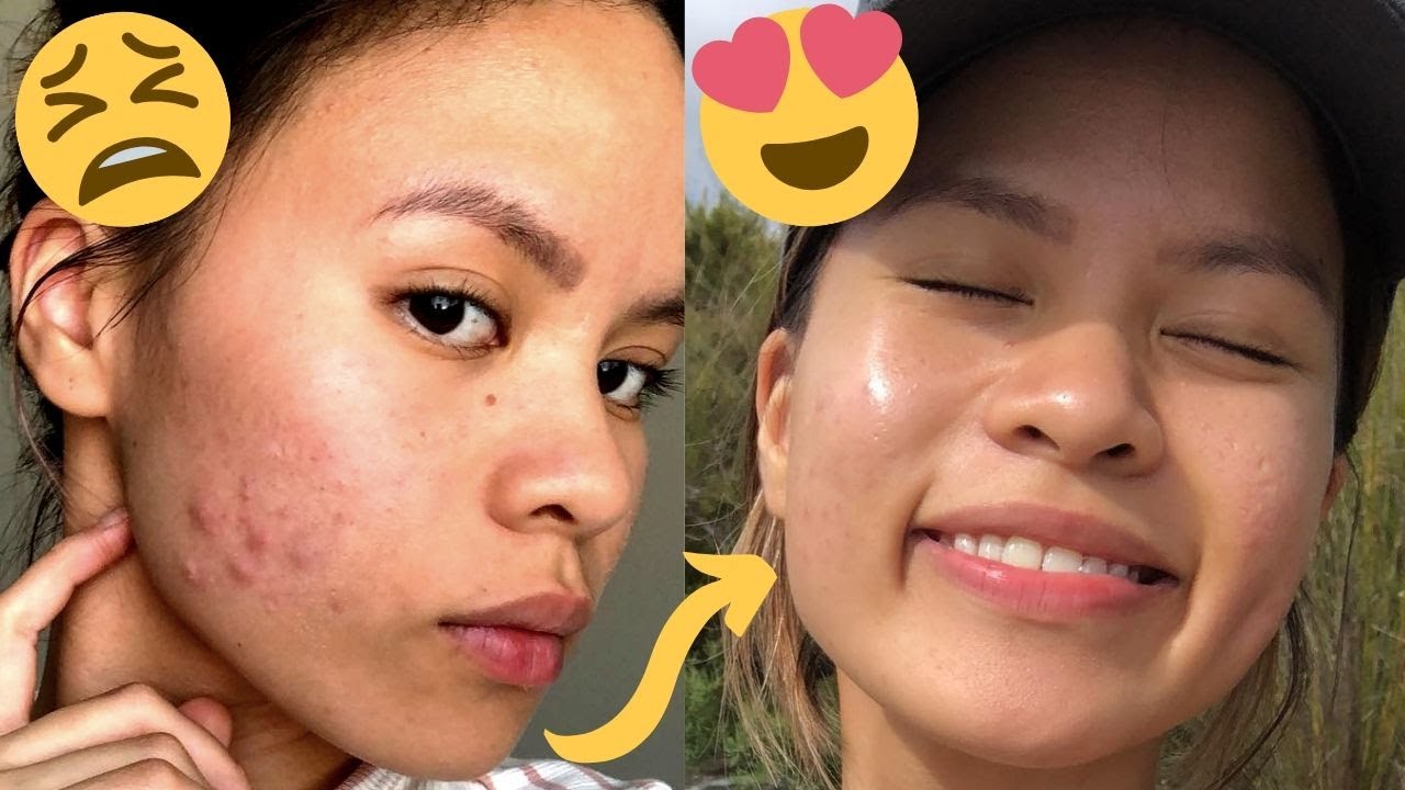 How I Healed my Acne in 10 Days