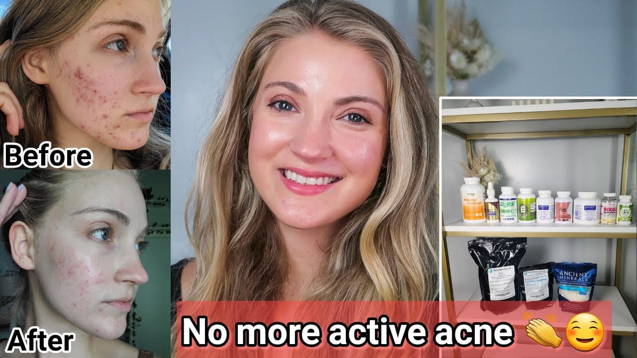 How I Healed My Adult Cystic Acne Naturally (WITHOUT ACCUTANE) + What Supplements I'm Taking Now