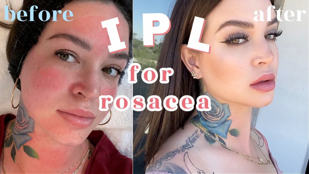 How I treat my ROSACEA !  IPL Photofacial ?? THE FACIAL THAT CHANGED MY FACE