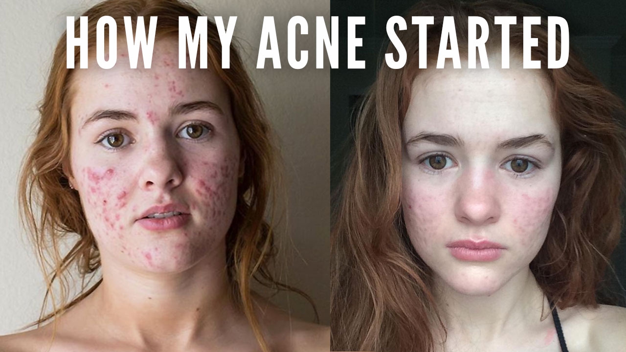 HOW MY ACNE STARTED
