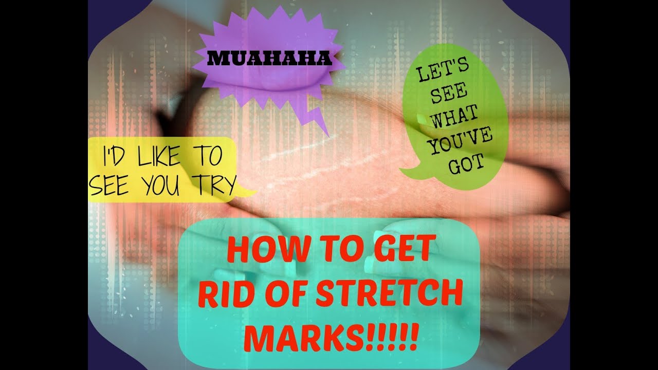 HOW STRETCH MARKS FORM AND HOW TO GET RID OF THEM: DML STYLE