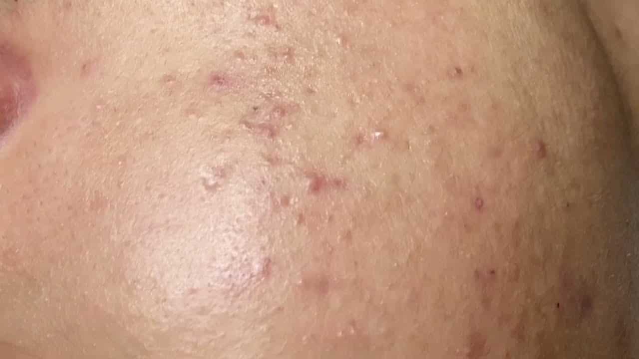 How to clean blackheads?Thank you for watching.
