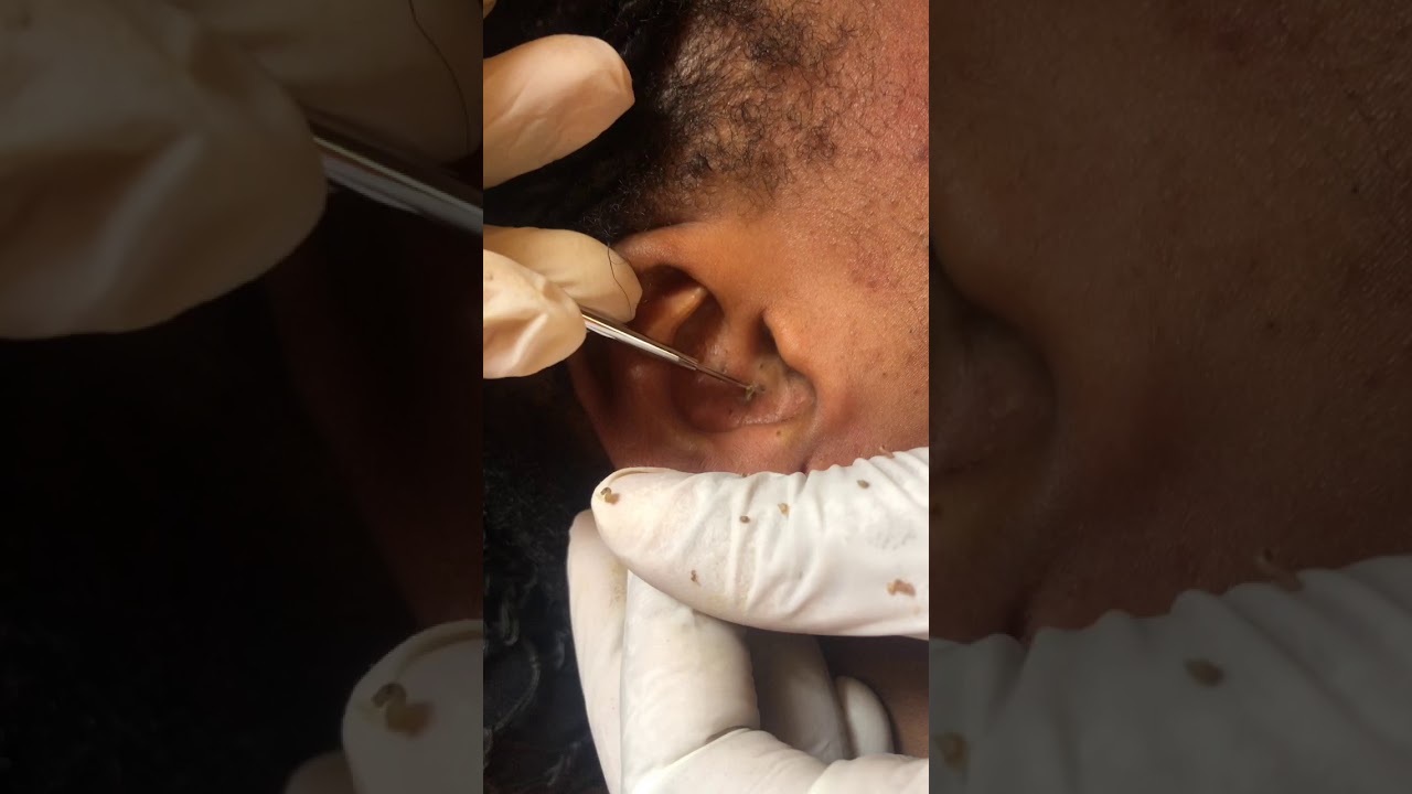 How to clear pimple /zit extraction facials