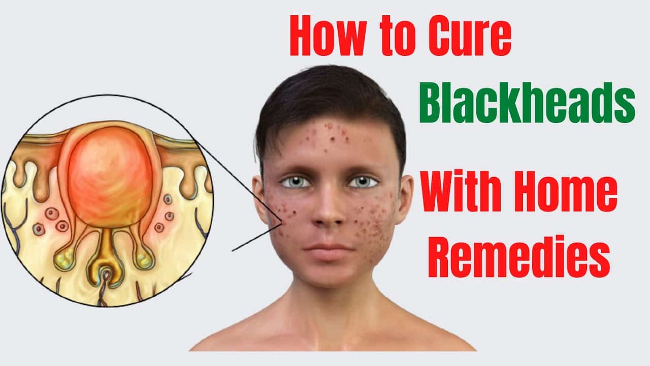 How to Cure Blackheads With Home Remedies [2 Critical Things You Must Do]