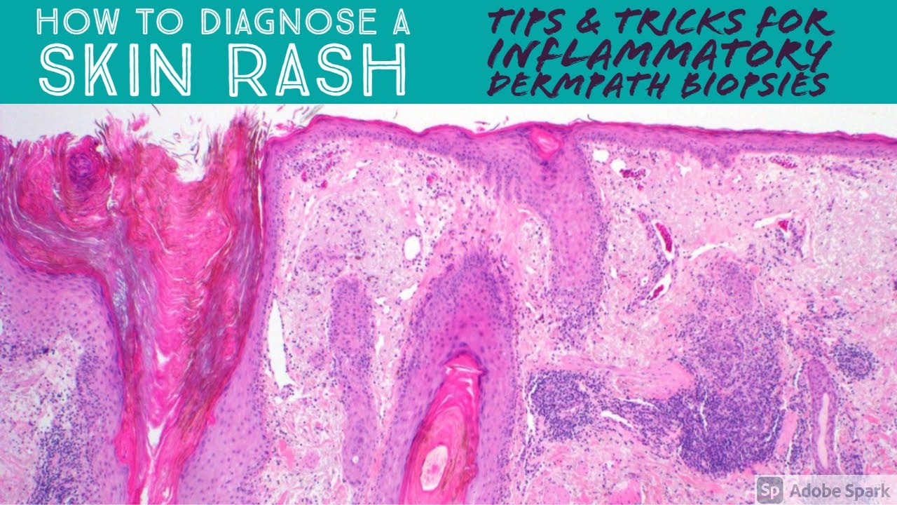 How to Diagnose Skin Rash: Tips & Tricks for Inflammatory Dermpath Skin Biopsy Pathology Dermatology