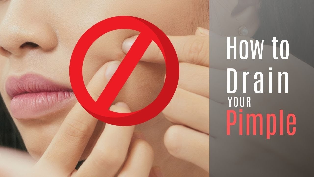How to Drain Your Pimple to Get Rid of a Popped Pimple!