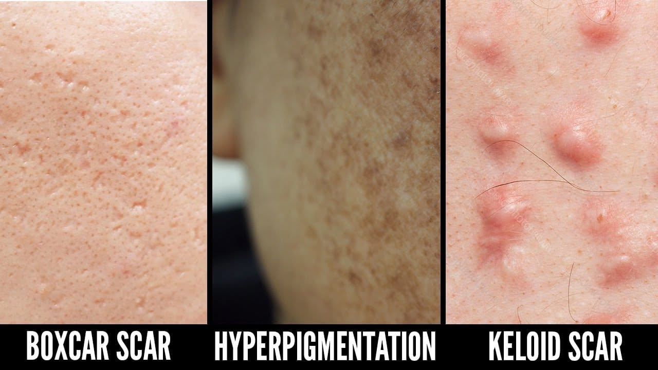 How To Effectively Treat Acne Scars & Hyperpigmentation!