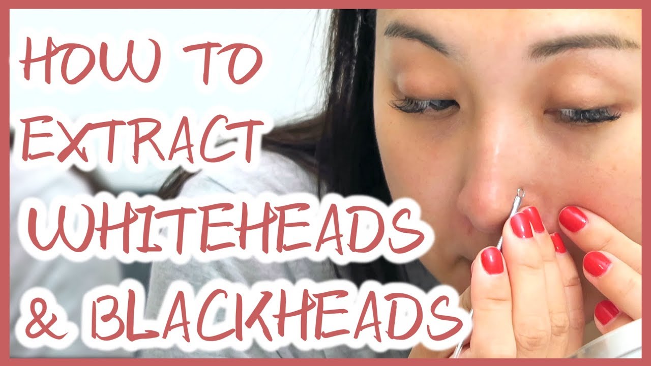 How To Extract Whiteheads And Blackheads Properly