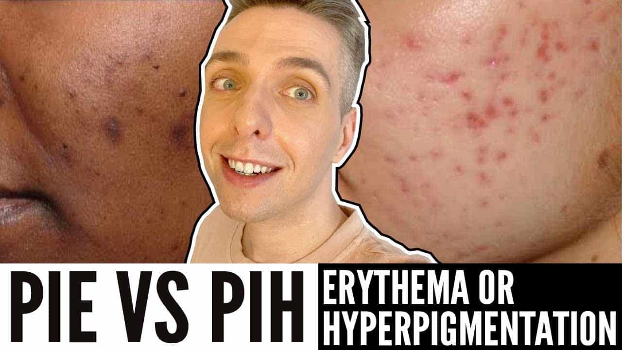 How to Fade Acne Marks! Finally Get Rid of Them–FAST! (PIE vs. PIH)