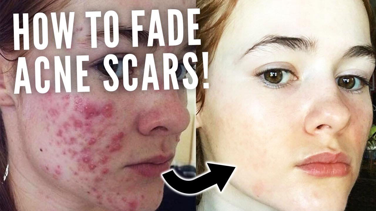 HOW TO FADE ACNE SCARS