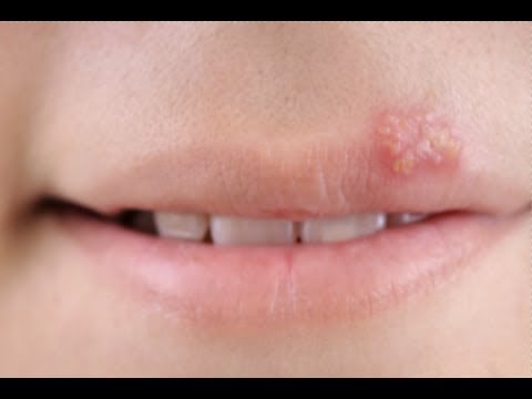 How to Get Rid of A Cold Sore Fast Overnight – Quick Cold Sore Treatment