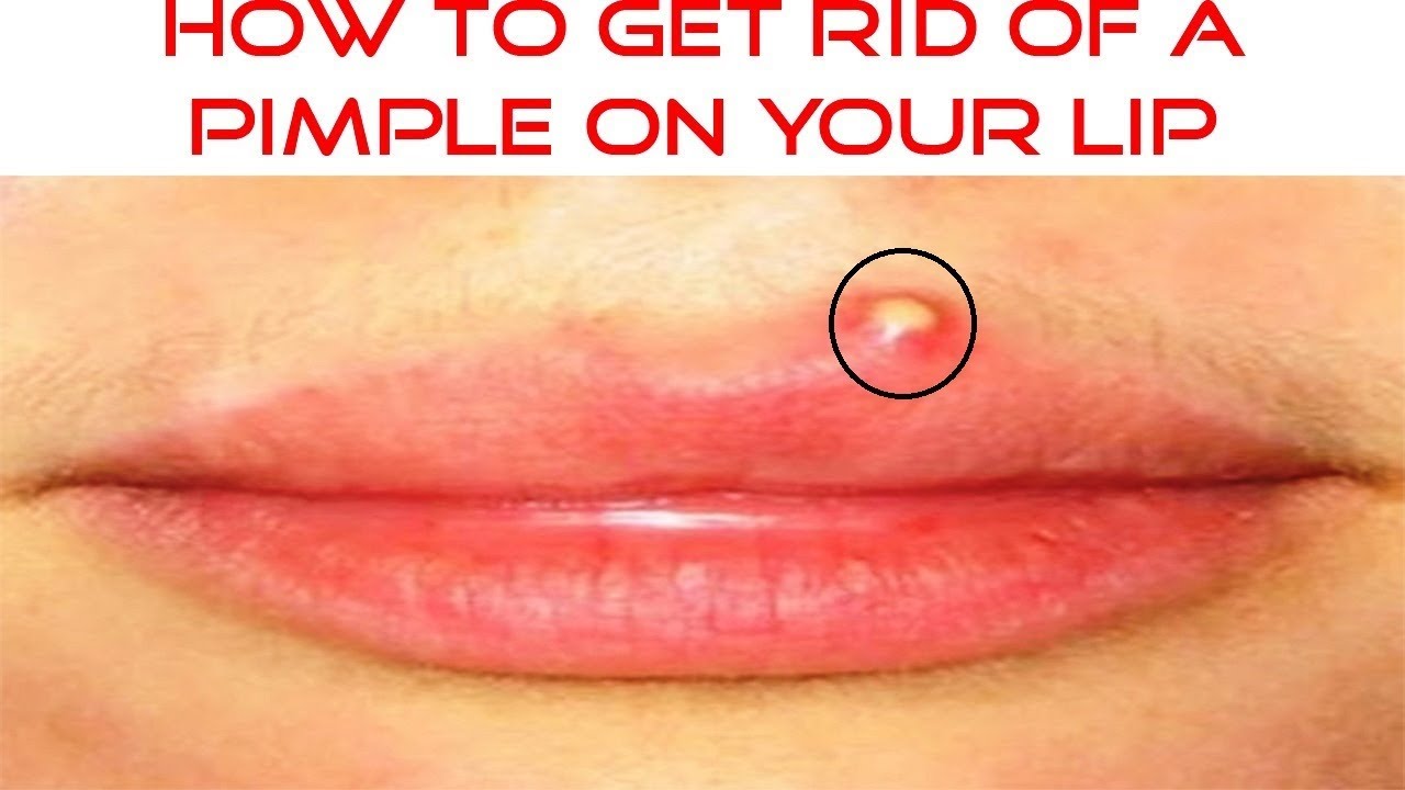 how to get rid of a pimple on your lip line