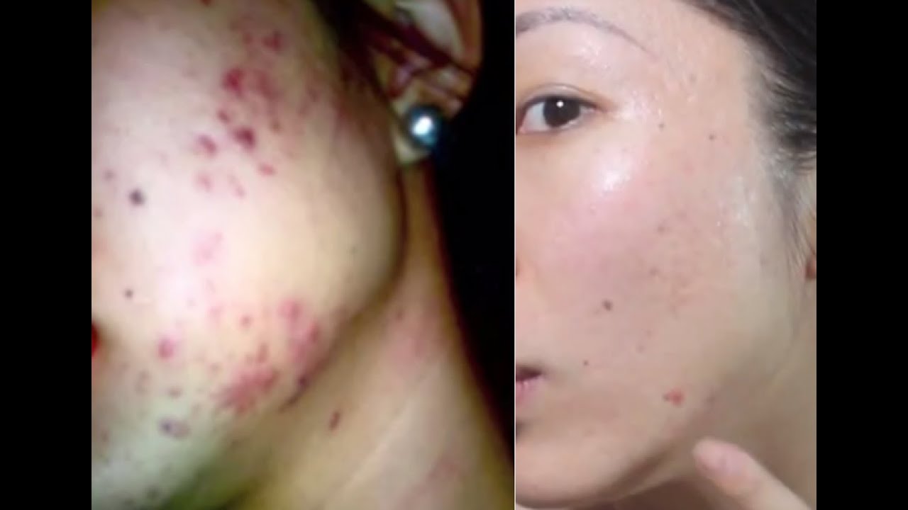 HOW TO GET RID OF ACNE, ACNE SCARRING