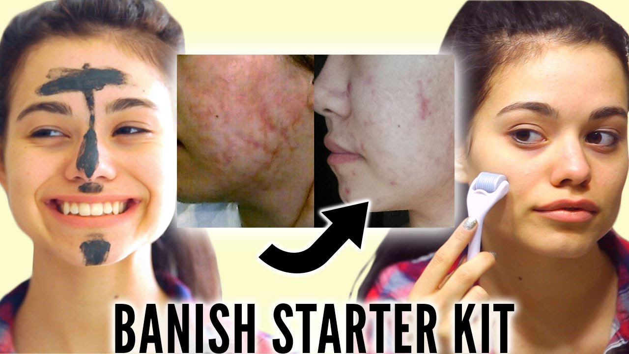 HOW TO GET RID OF ACNE, BLACKHEADS AND ACNE SCARS: THE BANISH STARTER KIT