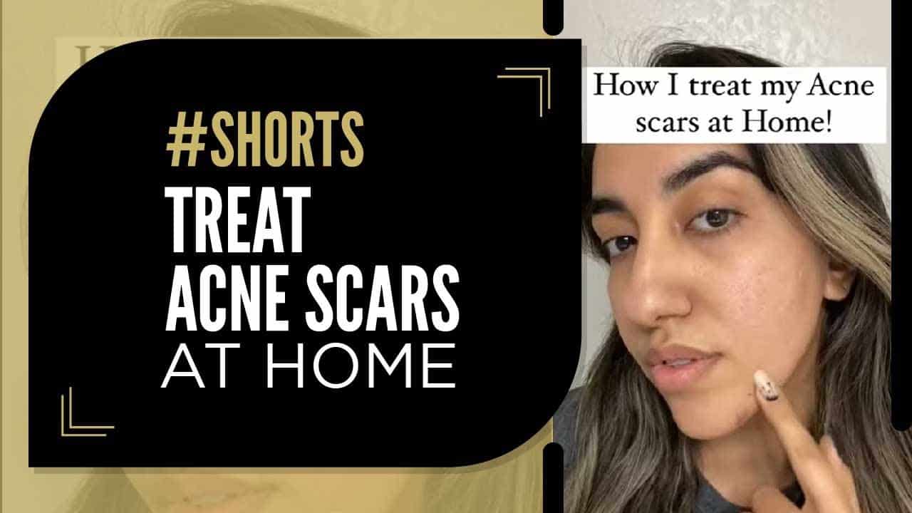 How to Get Rid of Acne Scars at Home | BANISH