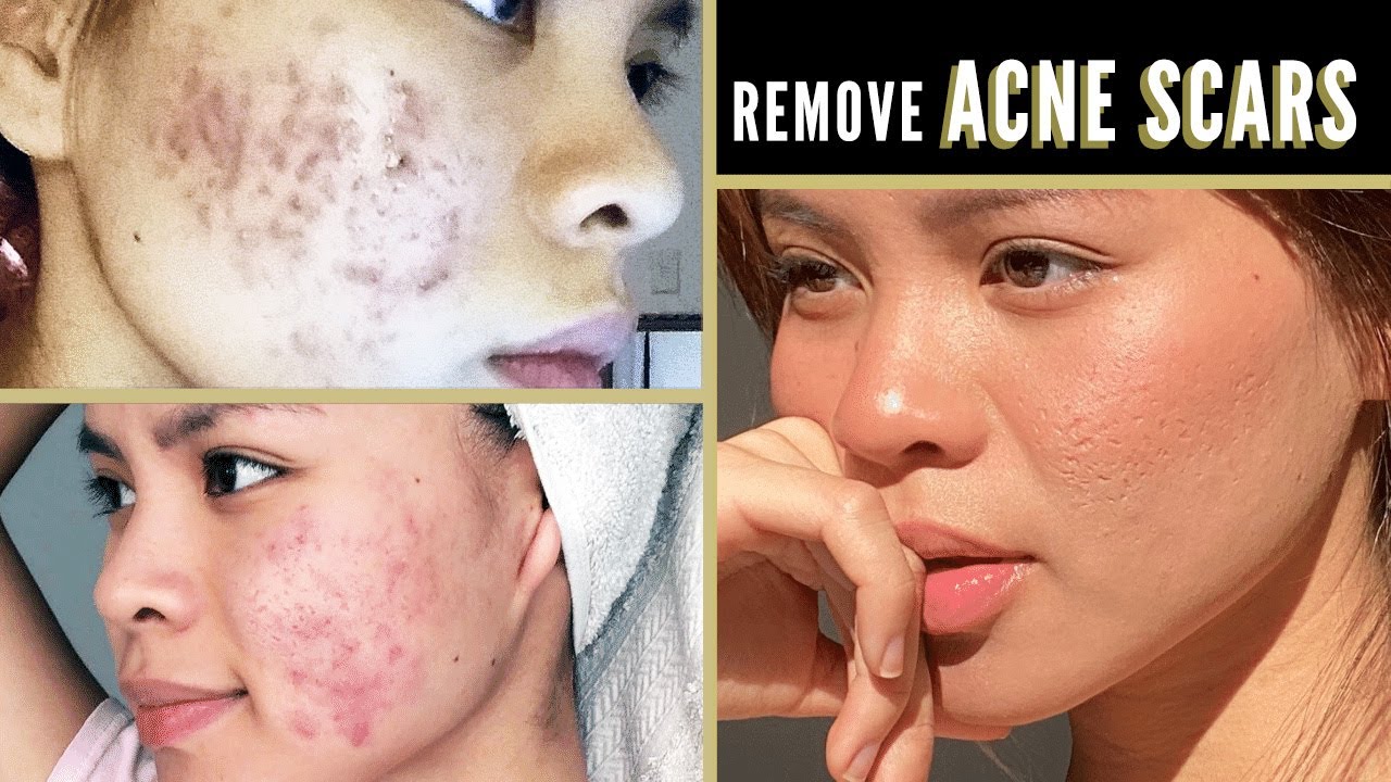 How To Get Rid Of Acne Scars For Good!