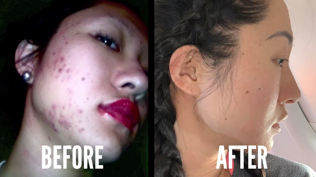 how to get rid of acne scars home remedies overnight