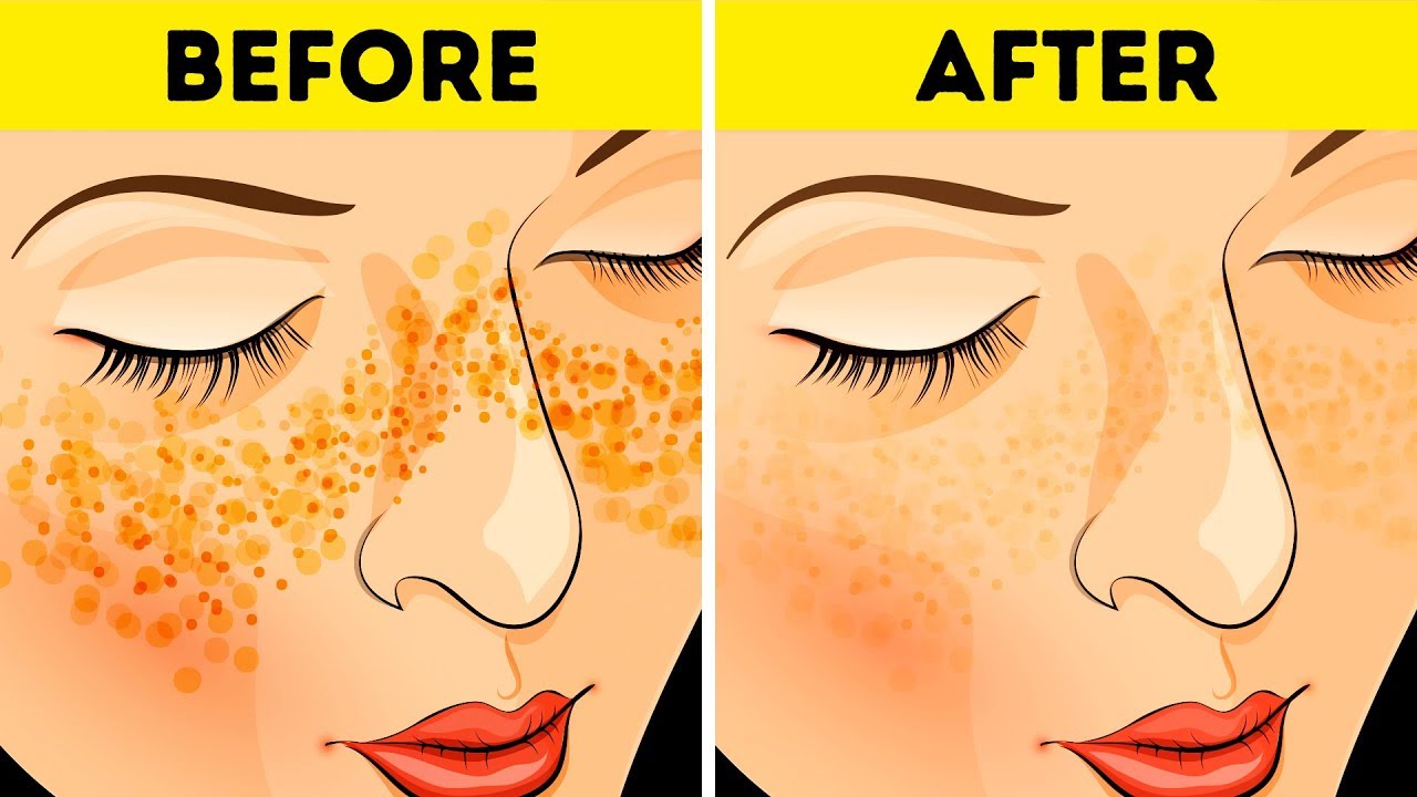 How to Get Rid of Acne Scars In Just 3 Days