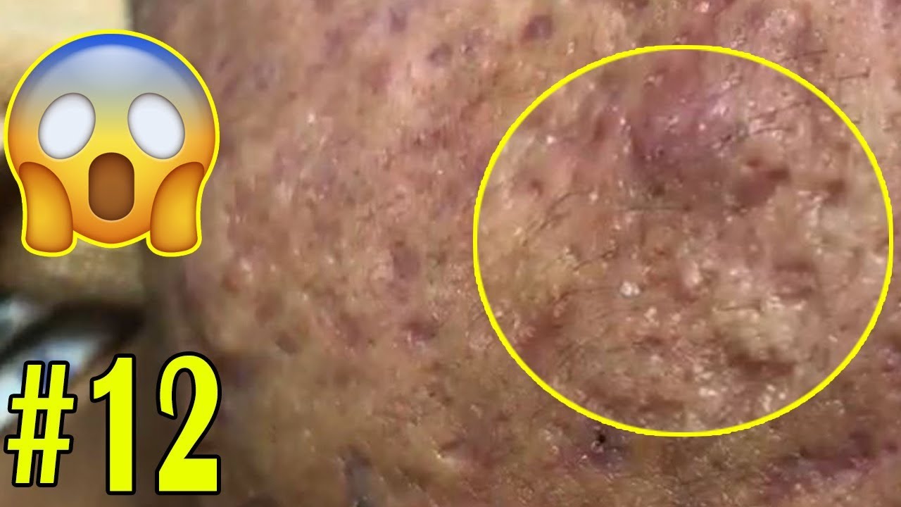 How to get rid of blackheads Awesome blackhead popping | Part12