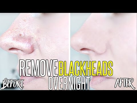 How To Get Rid Of Blackheads & Whiteheads OVERNIGHT !