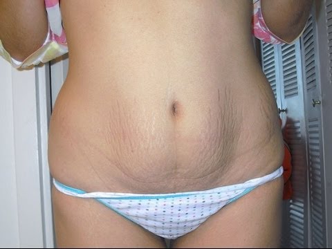 HOW TO GET RID OF CELLULITE AND STRETCH MARKS