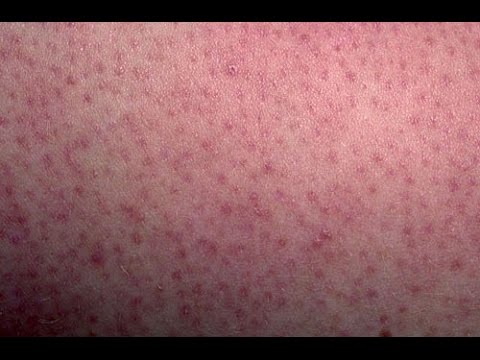 HOW TO GET RID OF CHICKEN SKIN ON ARMS, THIGHS AND BUTT: KEROTOSIS PILARSIS DML style