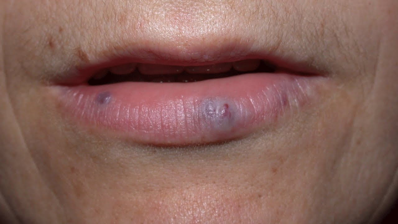 How to get rid of dark spots on lips?-Dr. Rasya Dixit