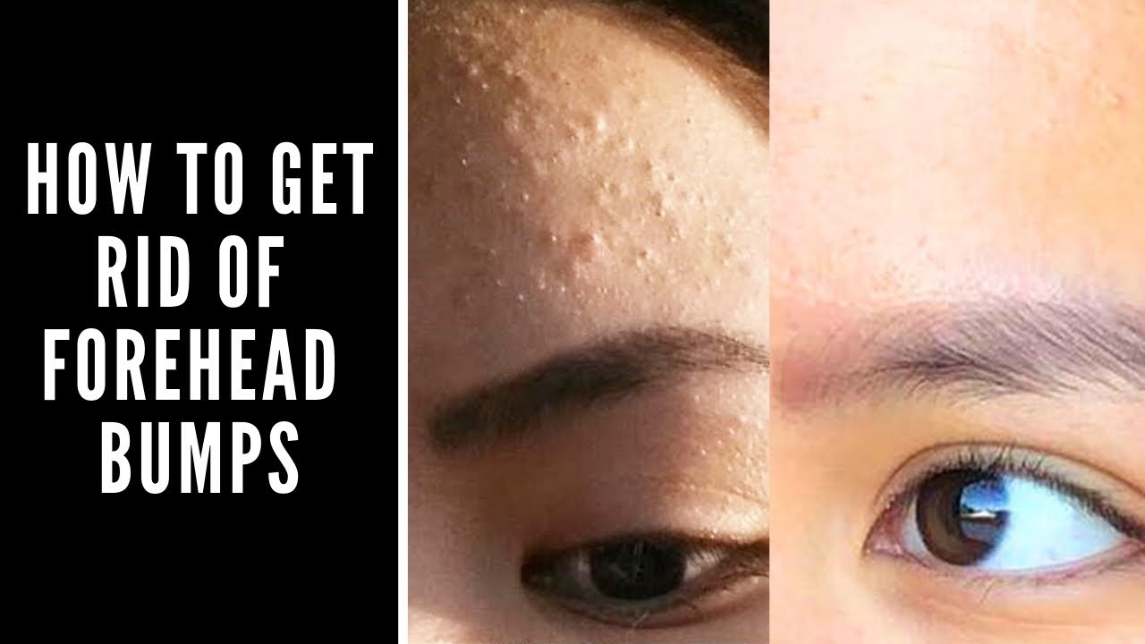 How to Get Rid of Forehead Bumps