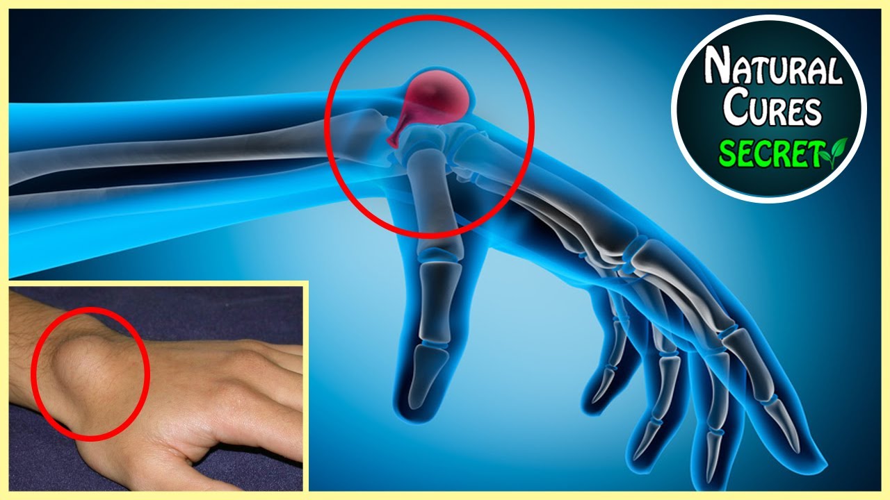 How To Get Rid of Ganglion Cysts Naturally At Home (Painful Bump on Wrist)