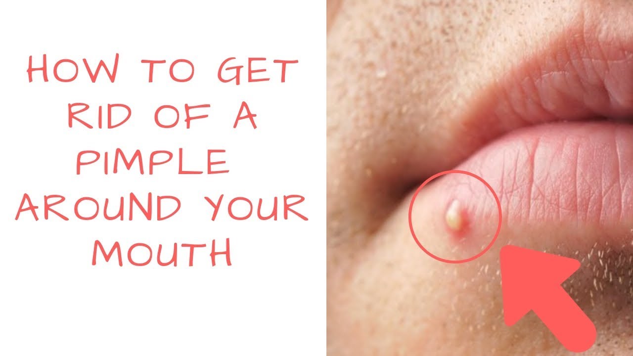 How to get rid of PIMPLES Around your mouth | PrettyBoyFloyd ?