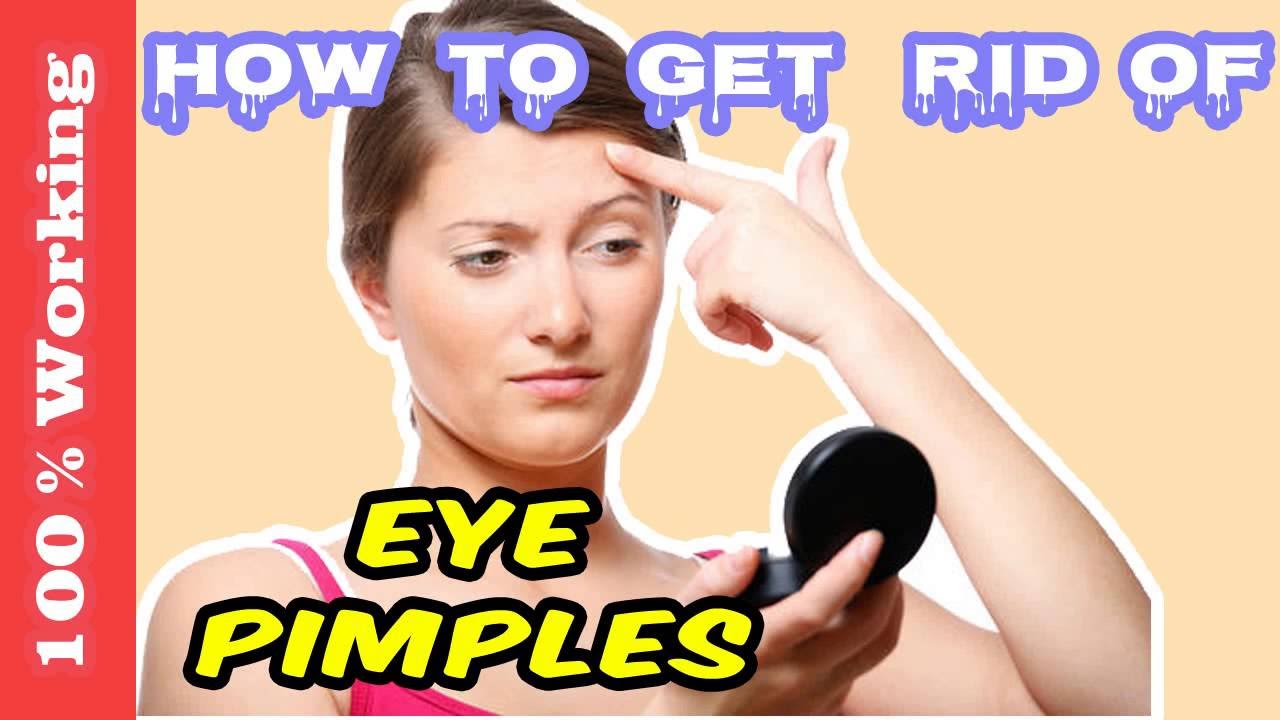 How To Get Rid Of Pimples On Eyelids Overnight – Fast – Home Remedies – Blackheads – Acne – Remove
