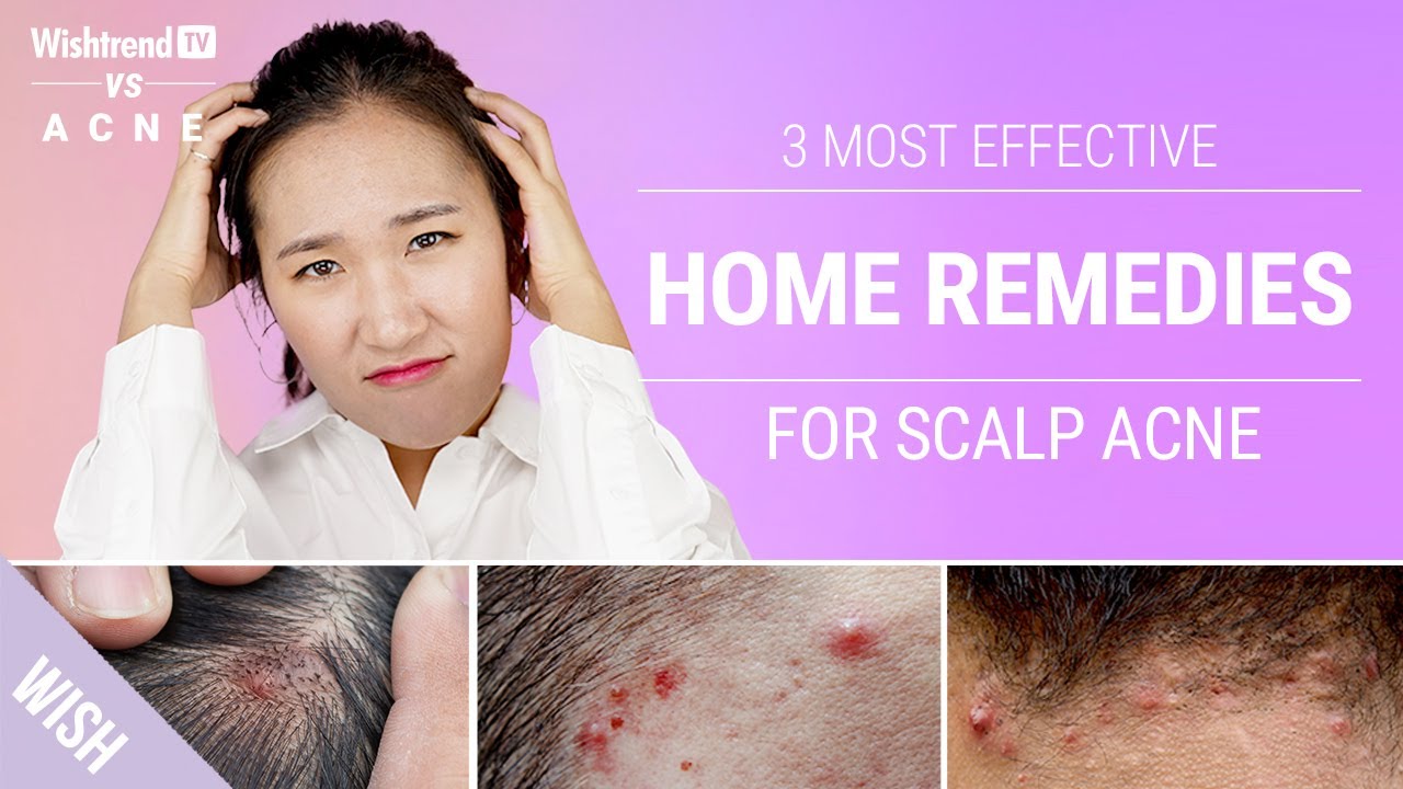 How to Get Rid of Scalp & Back of Neck Acne Naturally! | 3 Most Effective Home Remedies